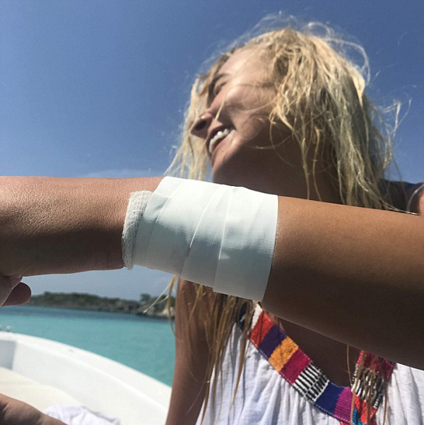 美网红模特海上漂浮拍照时被鲨鱼咬伤手腕