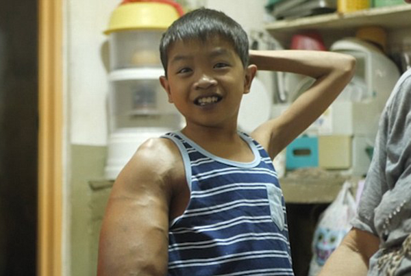 菲律宾11岁男孩因患怪病变成“大力水手”