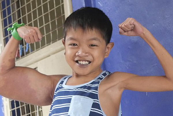菲律宾11岁男孩因患怪病变成“大力水手”