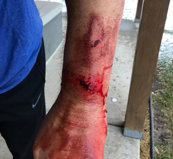 美国一男子狩猎时惨遭灰熊袭击 脸手均被抓伤