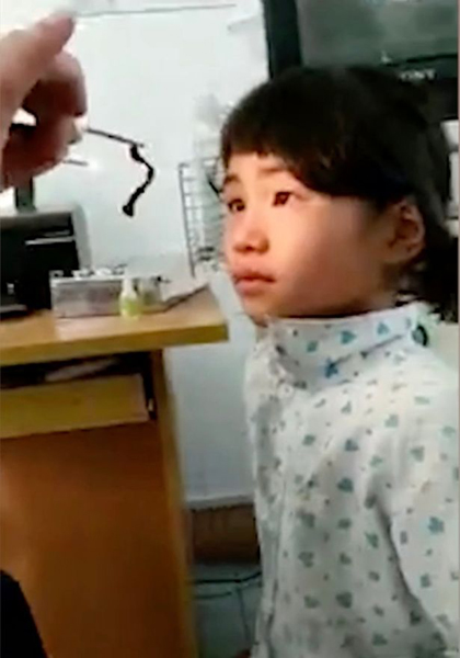 越南小女孩鼻子藏异物近1月 医生取出7.6厘米虫子