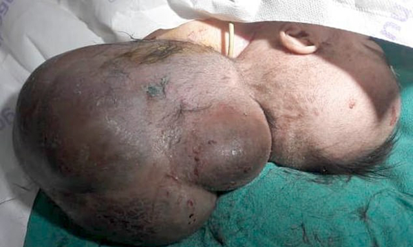印“双头”婴儿遭生父活埋 手术后迎全新人生