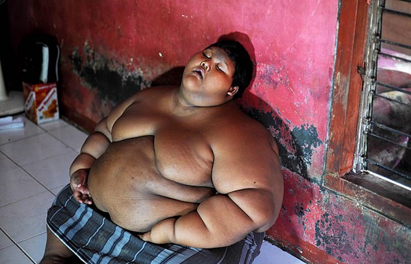 “世界最胖男孩”体重减半后皮肤松弛盼切除