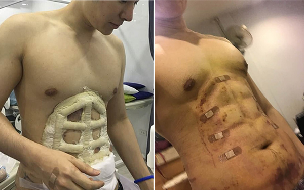 泰国一年轻男子花2万多元做手术塑造6块腹肌