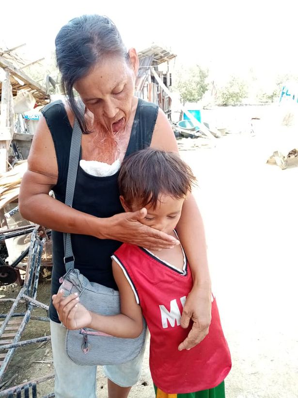 菲律宾一女子火灾后下巴与胸粘连 求助民众筹款治疗