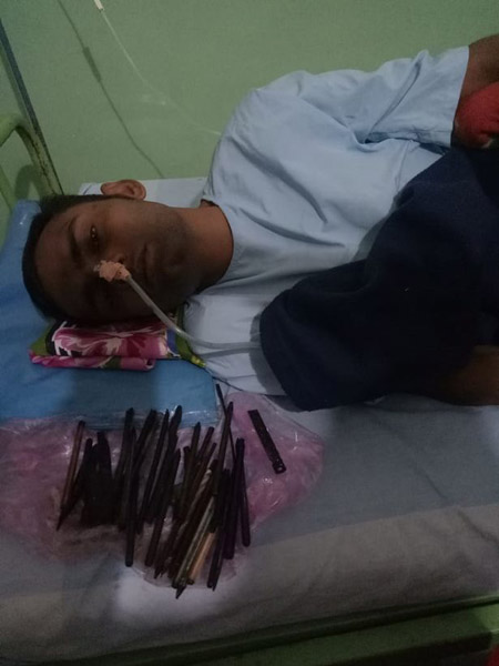 印度一男子腹痛 医生从其腹中取出30余件利器