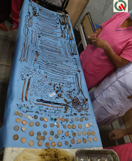 印度26岁女子患异食癖 吞下2.7斤珠宝与硬币