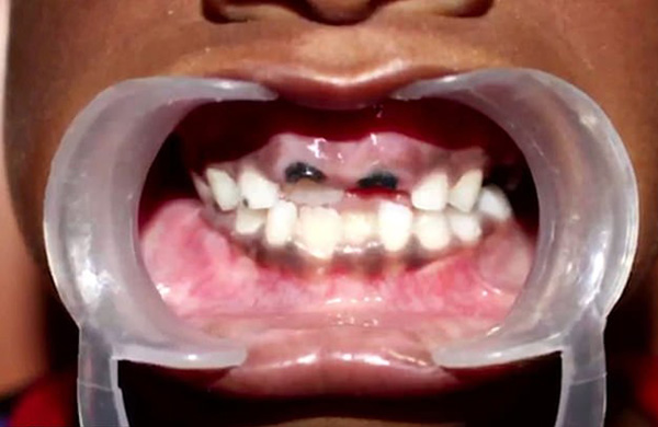 印度一7岁男孩下巴肿胀 医生从其口中拔出526颗“牙齿”