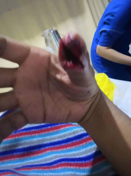 马来西亚一男子用保护膜破裂手机玩游戏 碎片嵌入手指四个月
