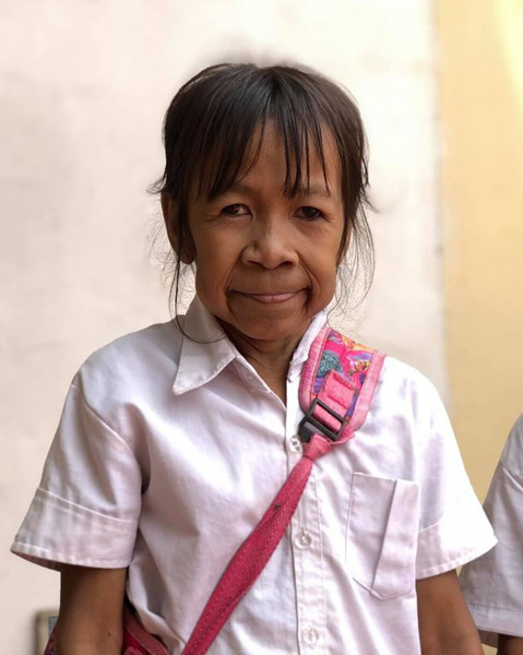柬埔寨10岁女孩满脸皱纹似六旬老人 常遭同伴取笑
