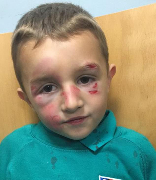 英国5岁男孩骑车被男子撞飞致脸部受伤 撞人者逃逸